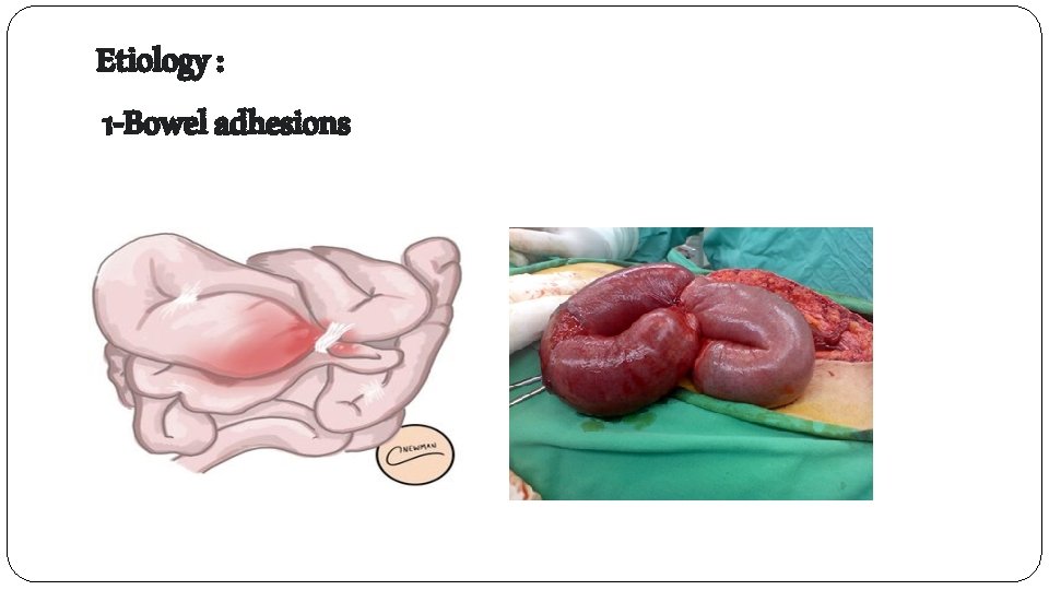 Etiology : 1 -Bowel adhesions 
