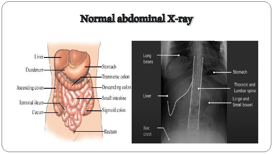 Normal abdominal X-ray 