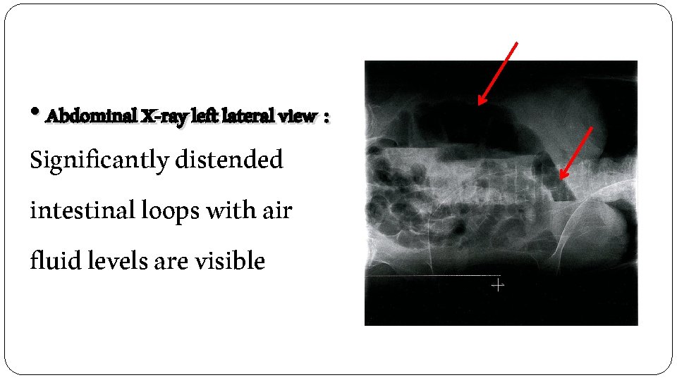  • Abdominal X-ray left lateral view : Significantly distended intestinal loops with air