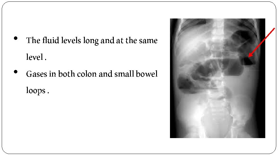  • The fluid levels long and at the same level. • Gases in