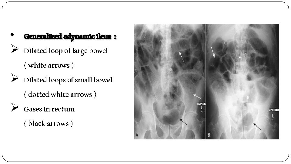  • Generalized adynamic ileus : Ø Dilated loop of large bowel ( white
