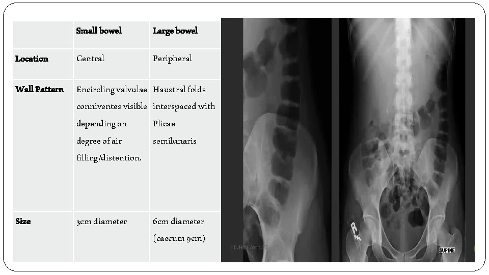 Location Small bowel Large bowel Central Peripheral Wall Pattern Encircling valvulae conniventes visible depending