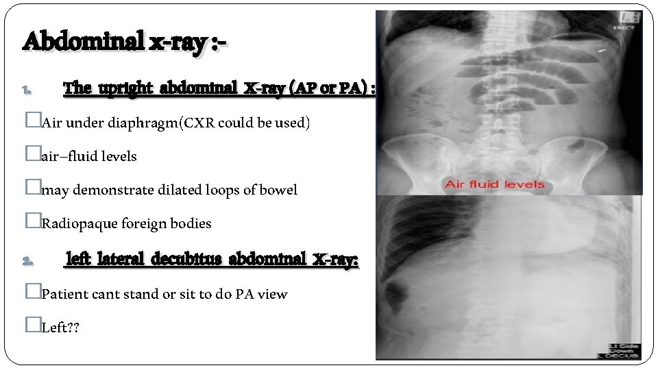 Abdominal x-ray : 1. The upright abdominal X-ray (AP or PA) : �Air under