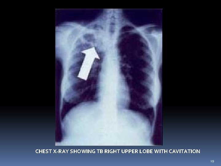 CHEST X-RAY SHOWING TB RIGHT UPPER LOBE WITH CAVITATION 19 