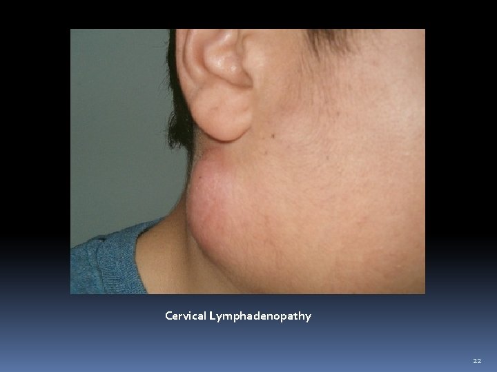 Cervical Lymphadenopathy 22 