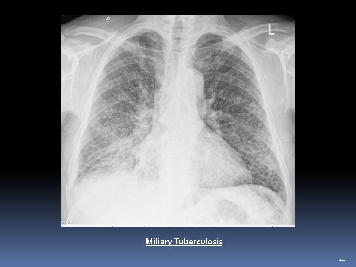 Miliary Tuberculosis 24 