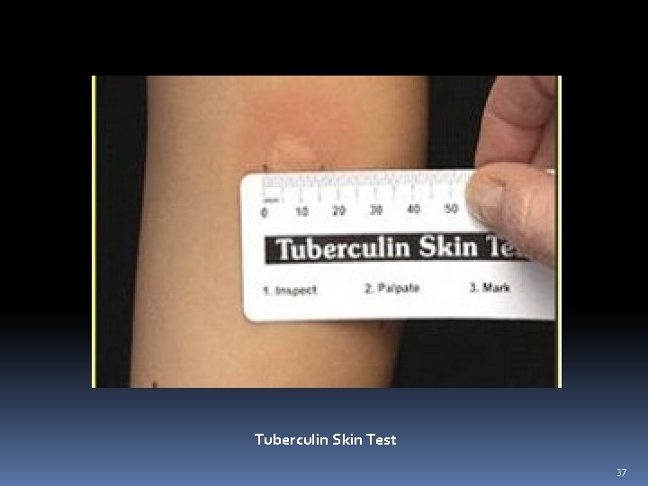 Tuberculin Skin Test 37 