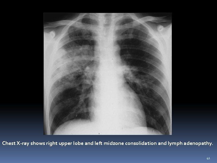 Chest X-ray shows right upper lobe and left midzone consolidation and lymph adenopathy. 41