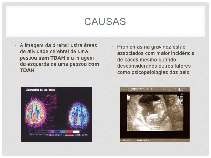 CAUSAS • A imagem da direita ilustra áreas de atividade cerebral de uma pessoa