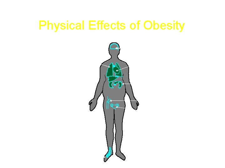 Physical Effects of Obesity Respiratory disease Stroke Cardiovascular Gall bladder disease Hormonal abnormalities Diabetes