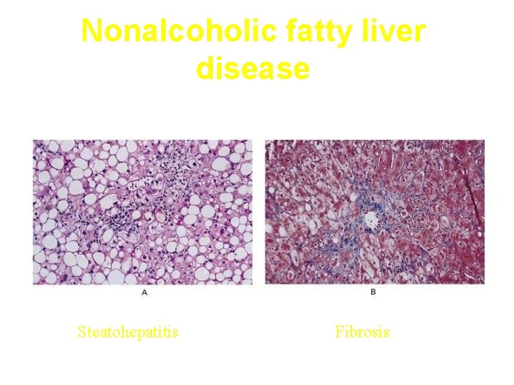 Nonalcoholic fatty liver disease Steatohepatitis Fibrosis NEJM 2002; 346: 1221 -1230 