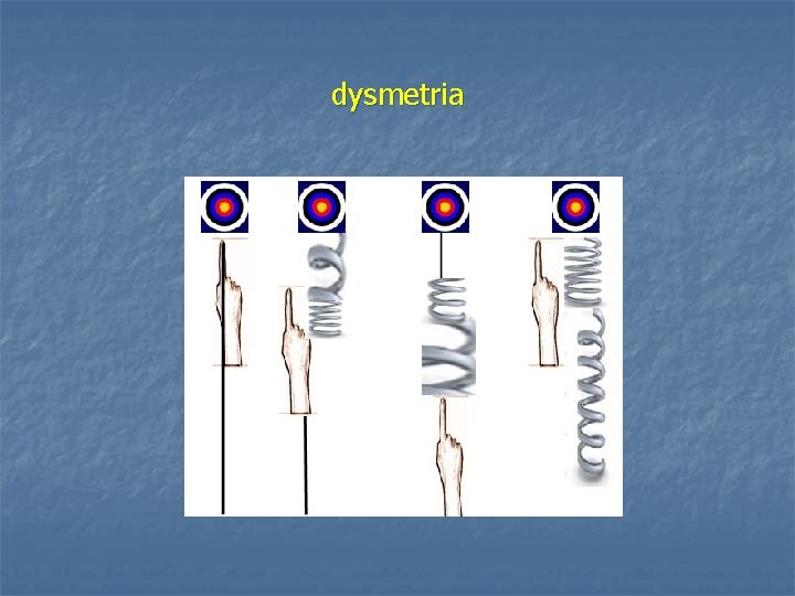 dysmetria 