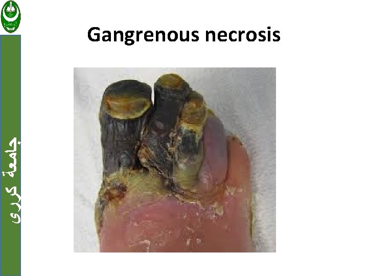  ﺟﺎﻣﻌﺔ ﻛﺮﺭﻱ Gangrenous necrosis 