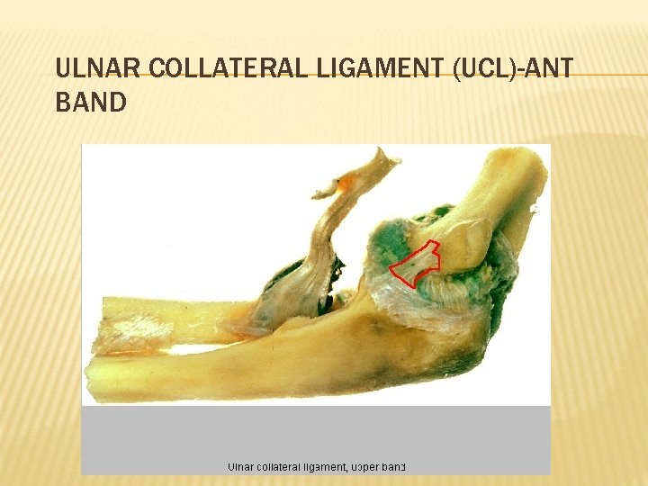 ULNAR COLLATERAL LIGAMENT (UCL)-ANT BAND 