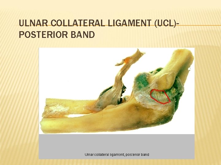 ULNAR COLLATERAL LIGAMENT (UCL)POSTERIOR BAND 