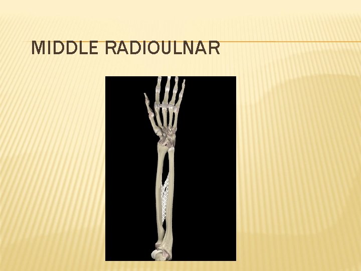 MIDDLE RADIOULNAR 