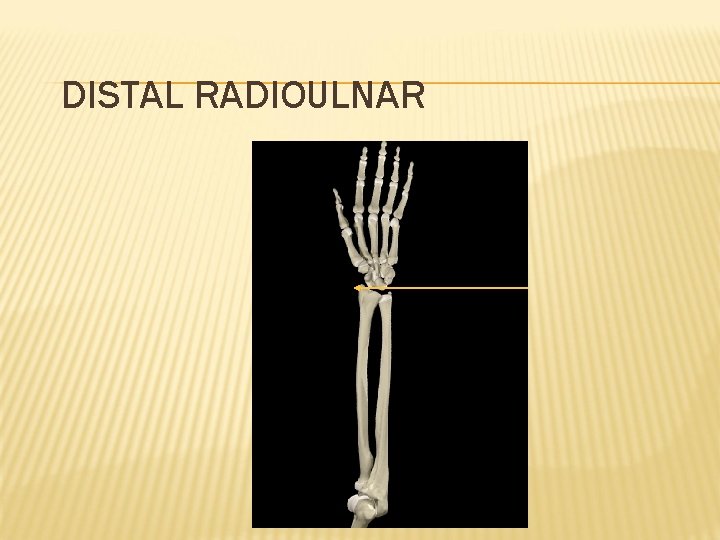 DISTAL RADIOULNAR 