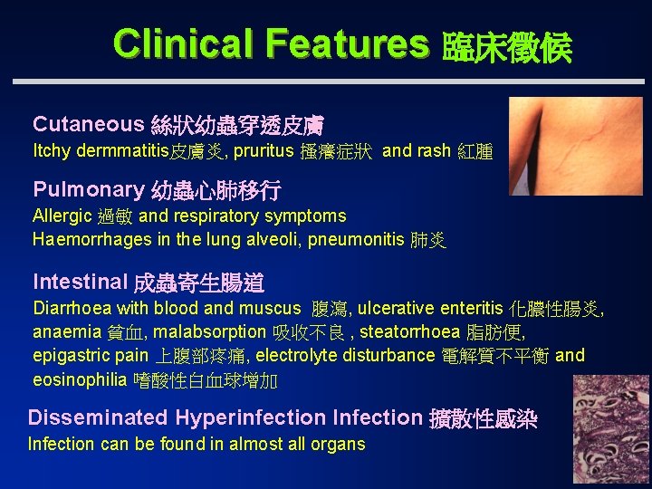 Clinical Features 臨床徵候 Cutaneous 絲狀幼蟲穿透皮膚 Itchy dermmatitis皮膚炎, pruritus 搔癢症狀 and rash 紅腫 Pulmonary 幼蟲心肺移行