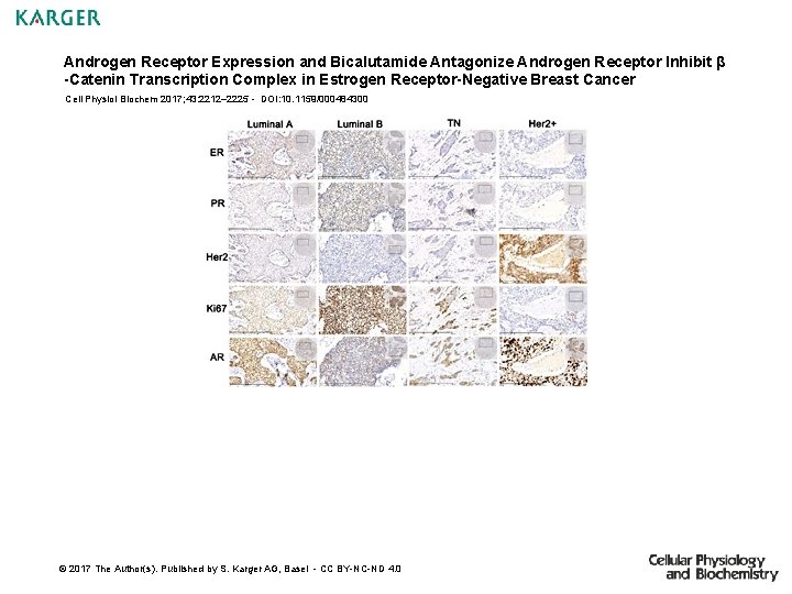 Androgen Receptor Expression and Bicalutamide Antagonize Androgen Receptor Inhibit β -Catenin Transcription Complex in