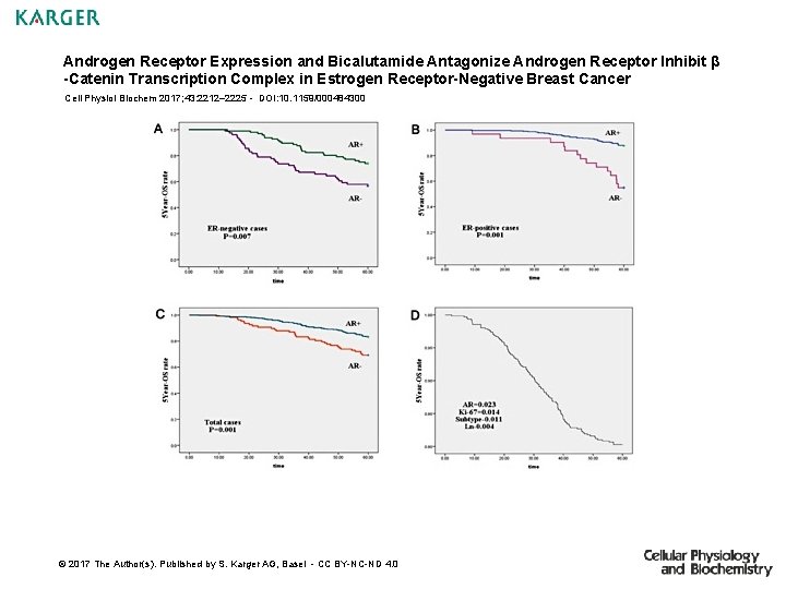 Androgen Receptor Expression and Bicalutamide Antagonize Androgen Receptor Inhibit β -Catenin Transcription Complex in