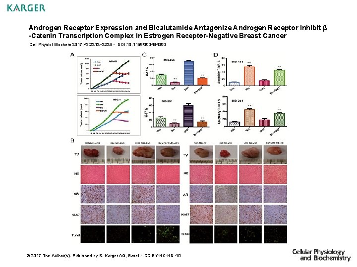Androgen Receptor Expression and Bicalutamide Antagonize Androgen Receptor Inhibit β -Catenin Transcription Complex in
