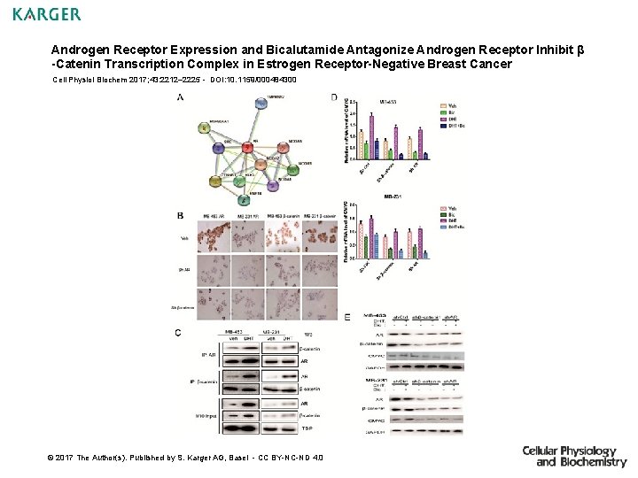 Androgen Receptor Expression and Bicalutamide Antagonize Androgen Receptor Inhibit β -Catenin Transcription Complex in