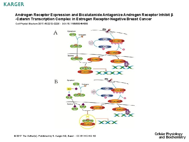 Androgen Receptor Expression and Bicalutamide Antagonize Androgen Receptor Inhibit β -Catenin Transcription Complex in