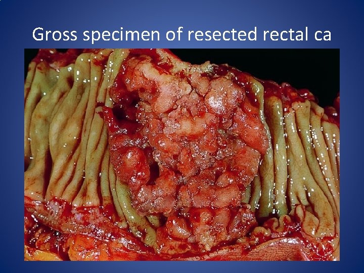 Gross specimen of resected rectal ca 