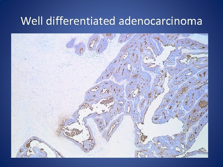 Well differentiated adenocarcinoma 