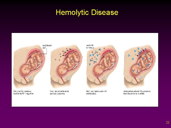 Hemolytic Disease 22 