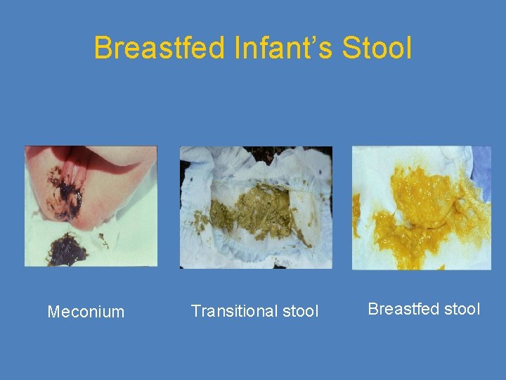 Breastfed Infant’s Stool Meconium Transitional stool Breastfed stool 