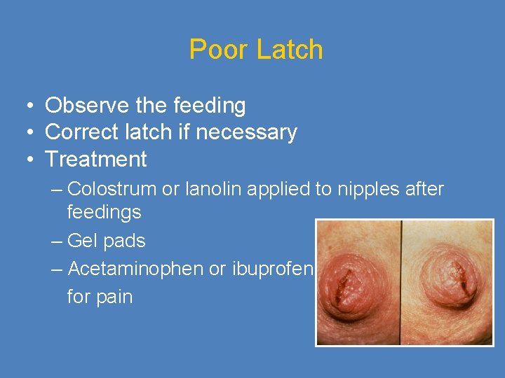 Poor Latch • Observe the feeding • Correct latch if necessary • Treatment –