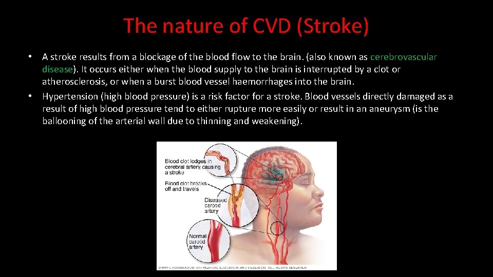 The nature of CVD (Stroke) • A stroke results from a blockage of the
