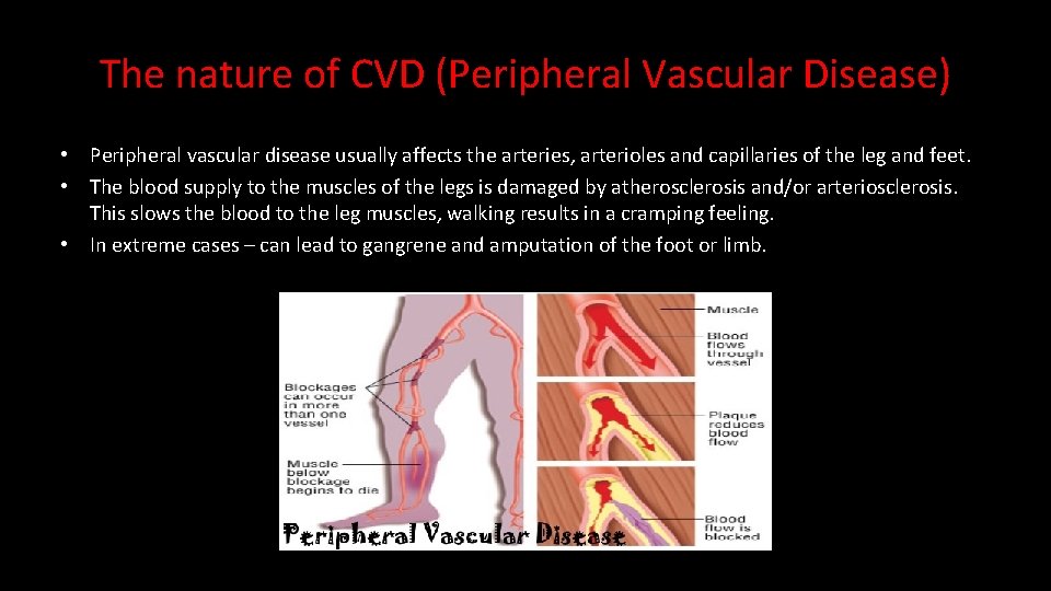 The nature of CVD (Peripheral Vascular Disease) • Peripheral vascular disease usually affects the