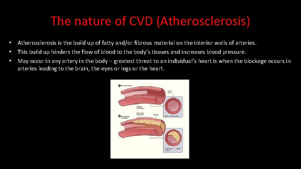 The nature of CVD (Atherosclerosis) • Atherosclerosis is the build up of fatty and/or
