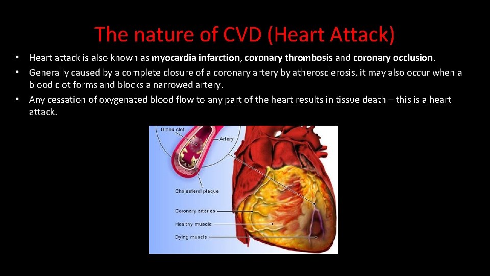 The nature of CVD (Heart Attack) • Heart attack is also known as myocardia