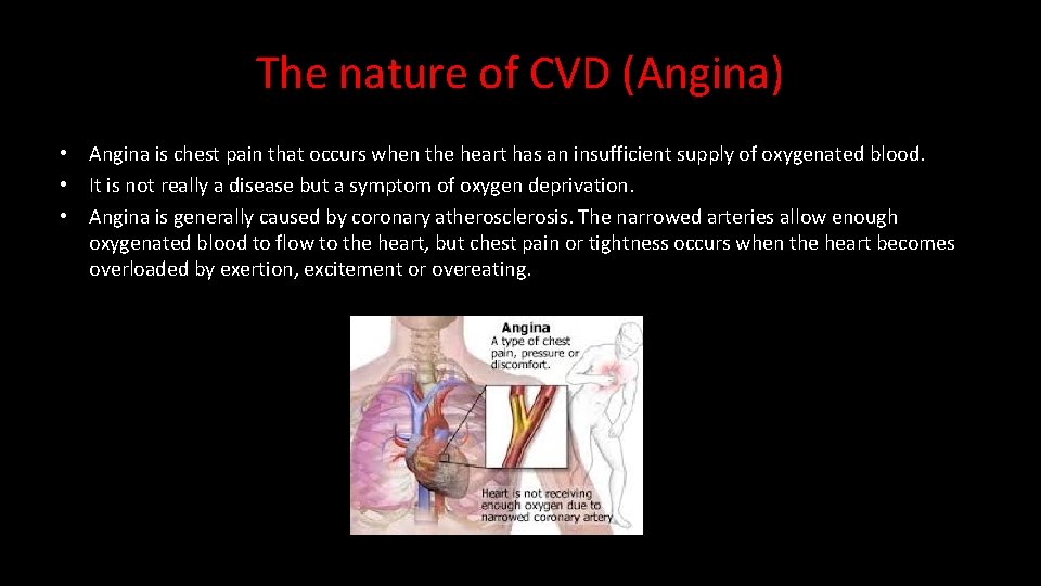 The nature of CVD (Angina) • Angina is chest pain that occurs when the