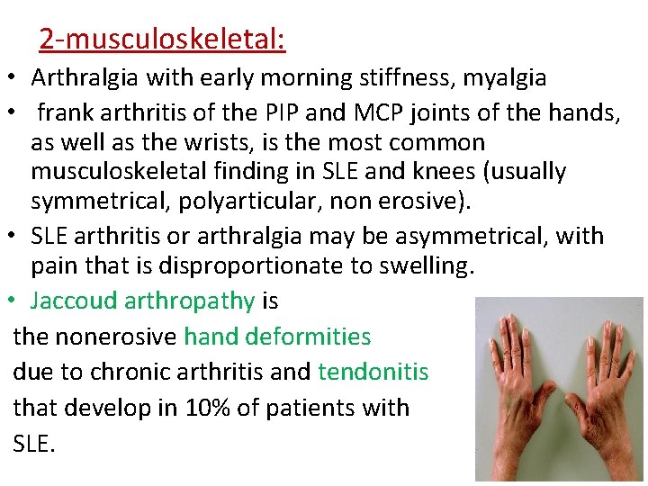 2 -musculoskeletal: • Arthralgia with early morning stiffness, myalgia • frank arthritis of the