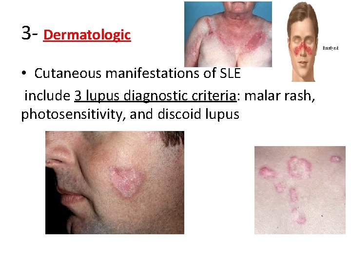 3 - Dermatologic • Cutaneous manifestations of SLE include 3 lupus diagnostic criteria: malar