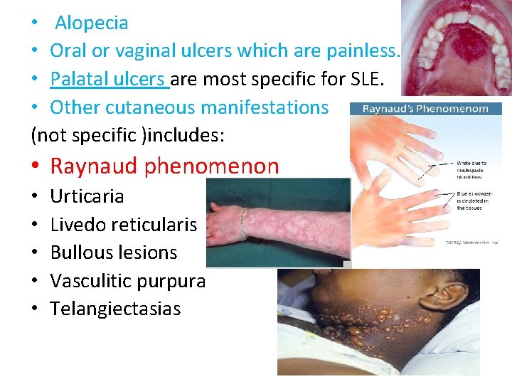  • Alopecia • Oral or vaginal ulcers which are painless. • Palatal ulcers