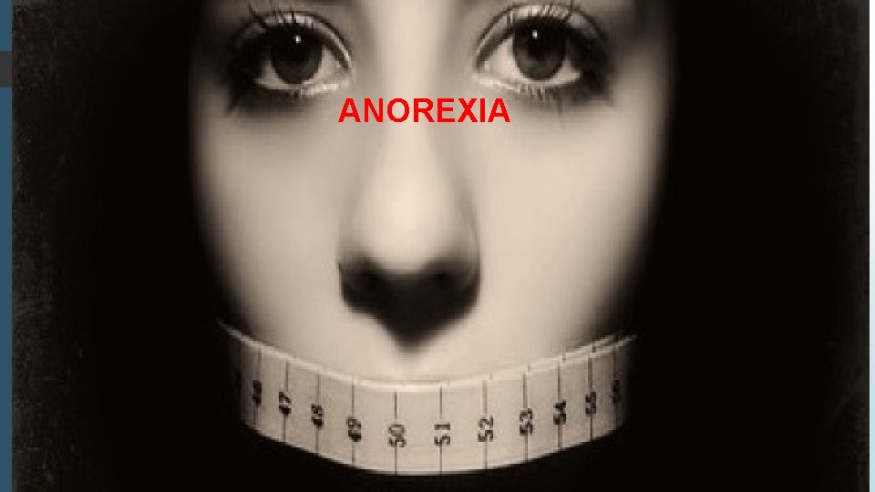 ANOREXIA 