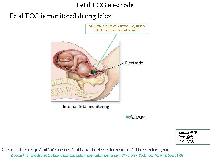 Fetal ECG electrode Fetal ECG is monitored during labor. Amniotic fluid is conductive. So,
