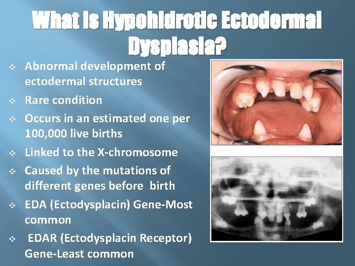 What is Hypohidrotic Ectodermal Dysplasia? v v v v Abnormal development of ectodermal structures