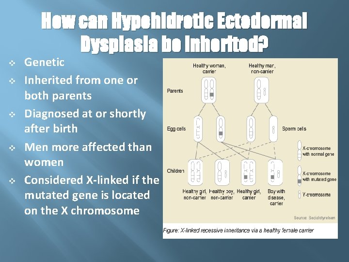 How can Hypohidrotic Ectodermal Dysplasia be inherited? v v v Genetic Inherited from one