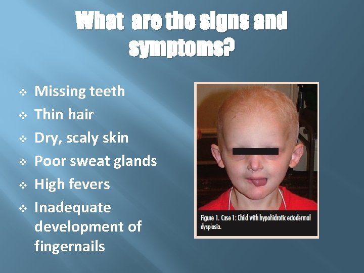 What are the signs and symptoms? v v v Missing teeth Thin hair Dry,