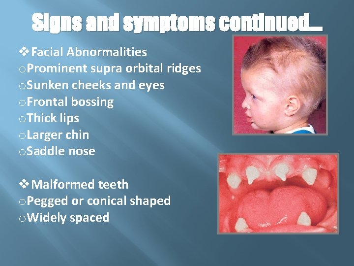 Signs and symptoms continued… v. Facial Abnormalities o. Prominent supra orbital ridges o. Sunken