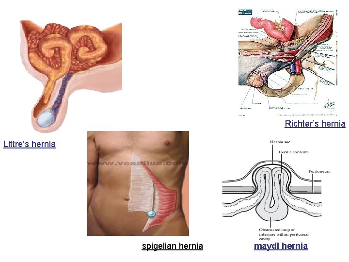 Richter’s hernia Littre’s hernia spigelian hernia maydl hernia 