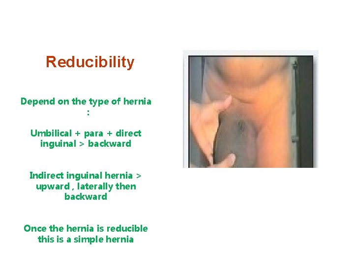 Reducibility Depend on the type of hernia : Umbilical + para + direct inguinal