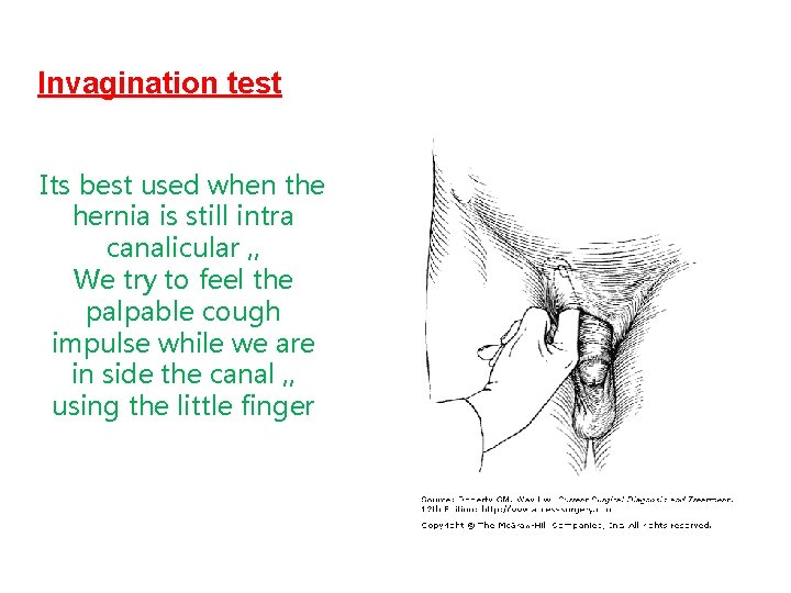 Invagination test Its best used when the hernia is still intra canalicular , ,
