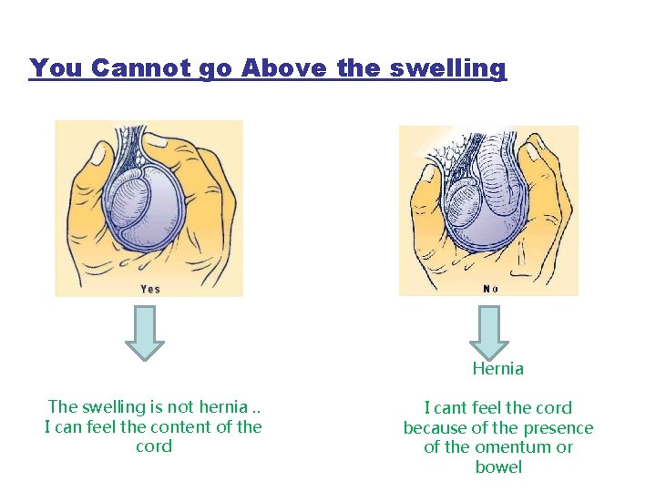 You Cannot go Above the swelling Hernia The swelling is not hernia. . I